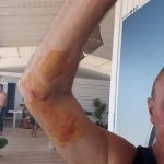 le ferite del surfista Mirko Bisi